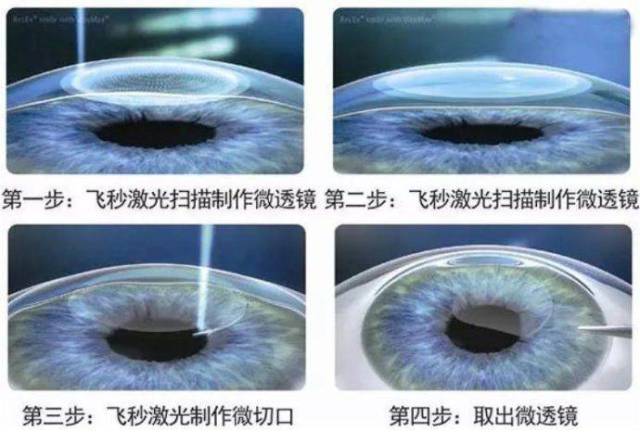 准分子激光手术